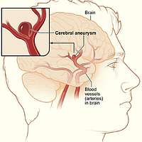 cerebral-aneurysm-nih-48c5c9-200